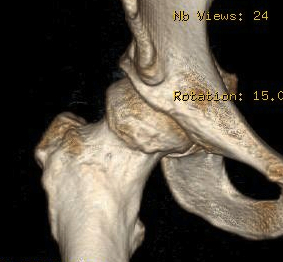 Hip CT Cam 3D